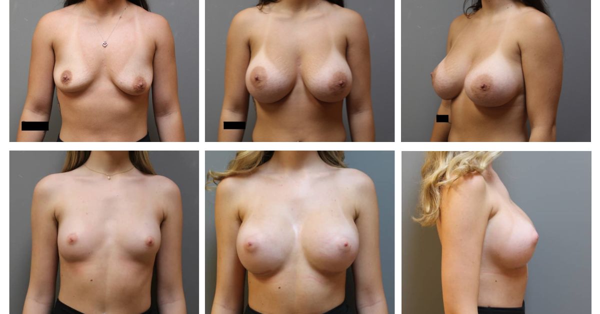 Two Breast Augmentation Before and After Case Photos